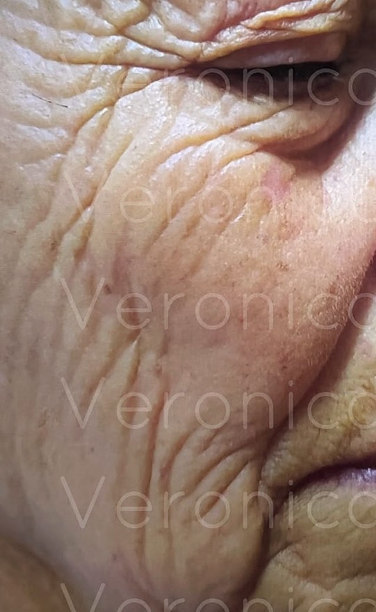 Antes: mejilla y contorno del ojo con arrugas profundas, en primer plano