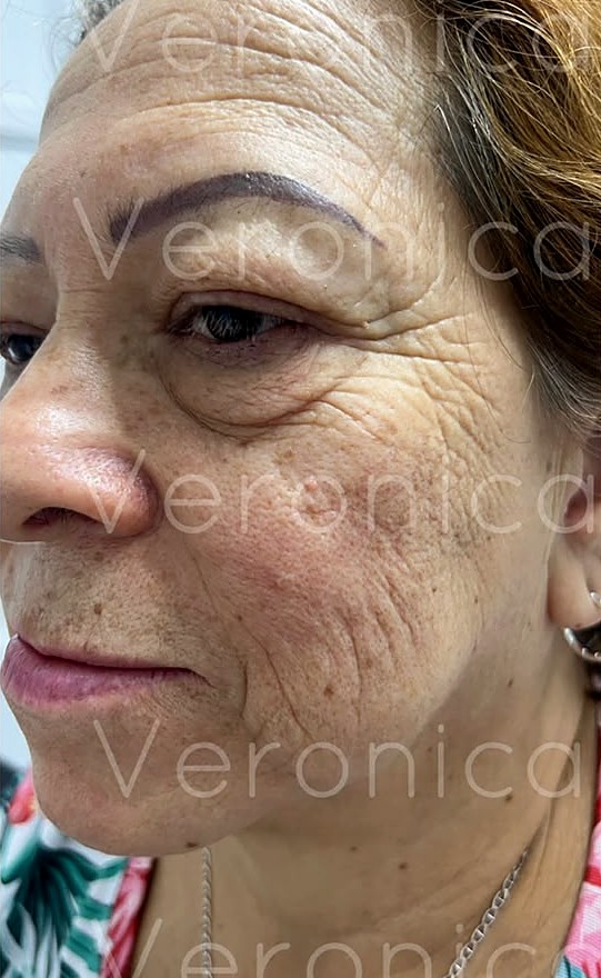 Antes: rostro de tres cuartos con arrugas marcadas en la frente, el contorno del ojo y la mejilla