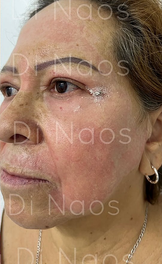 Después: el mismo rostro con la piel más lisa y la mejilla más firme