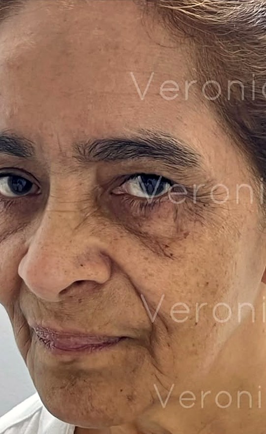 Antes: rostro con ojeras oscuras, manchas y arrugas