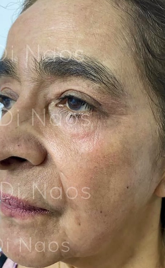 Después: el mismo rostro con la mirada más clara, tomado desde otro ángulo