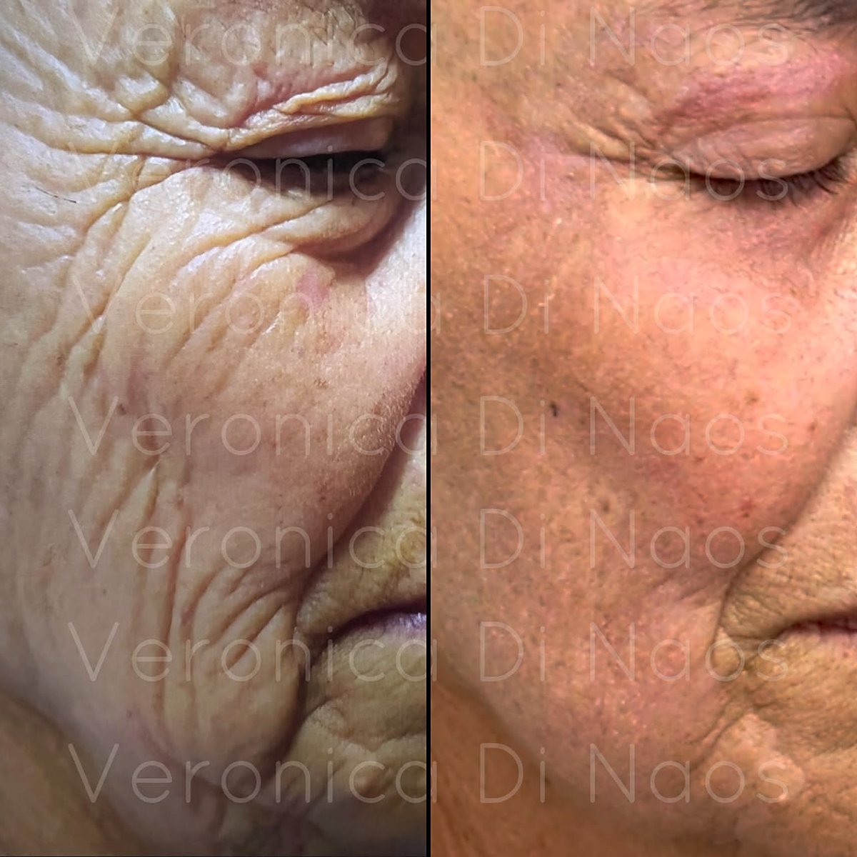 Antes y después en primer plano: mejilla con arrugas profundas, y la misma zona con la piel más tersa