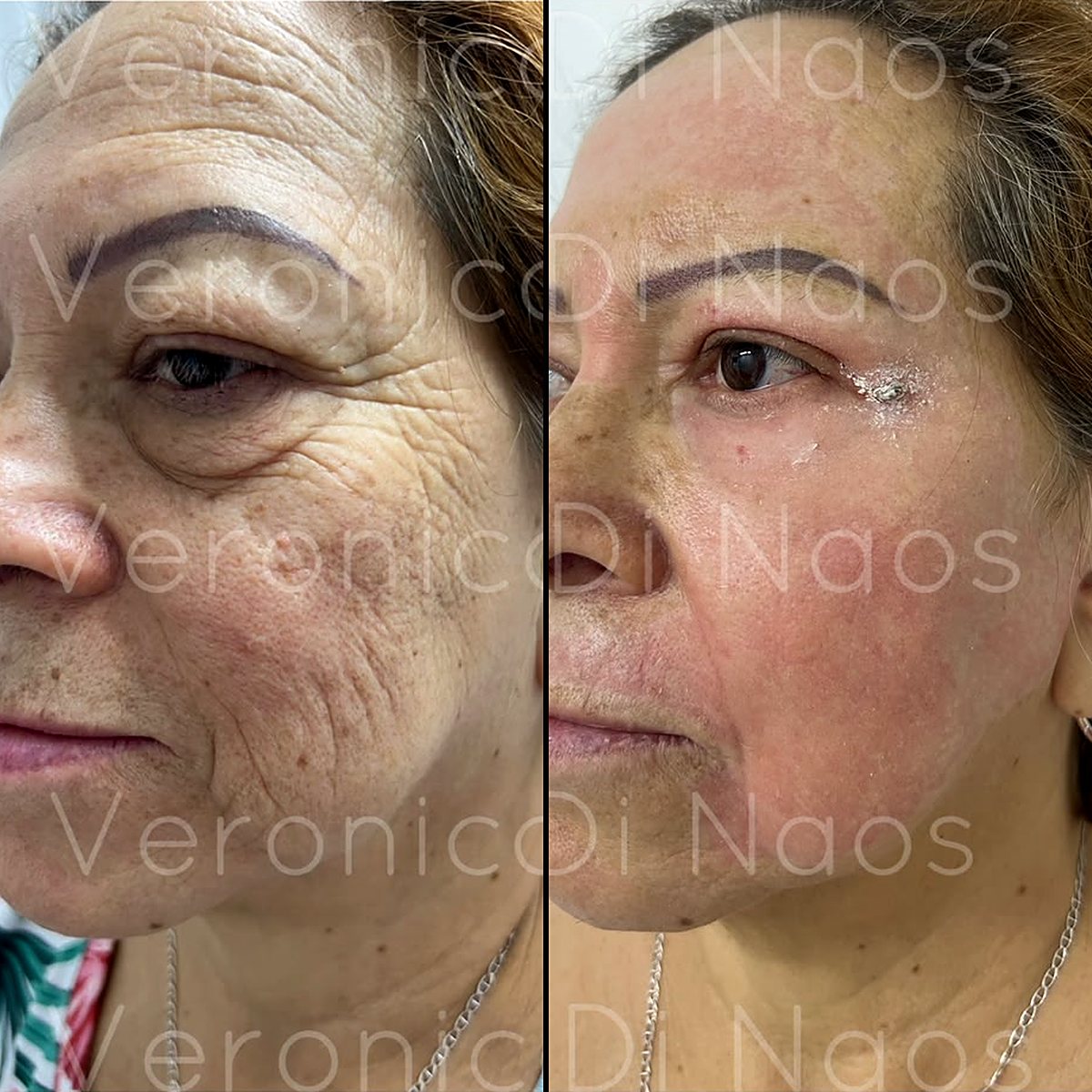 Caso real: rostro con arrugas marcadas antes, a la izquierda, y la piel más lisa después, a la derecha