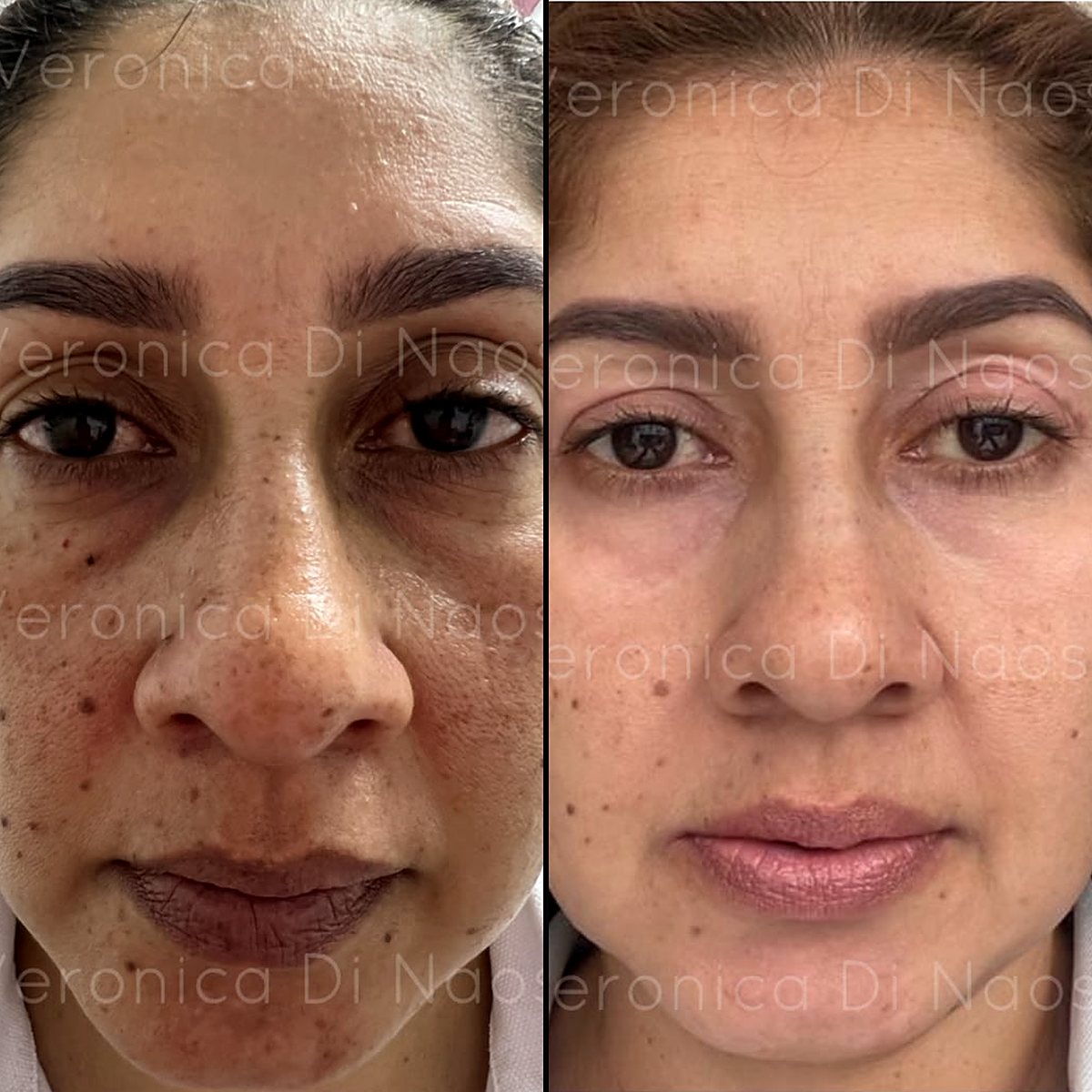 Caso real: rostro con pecas y manchas antes, a la izquierda, y el tono más parejo después, a la derecha