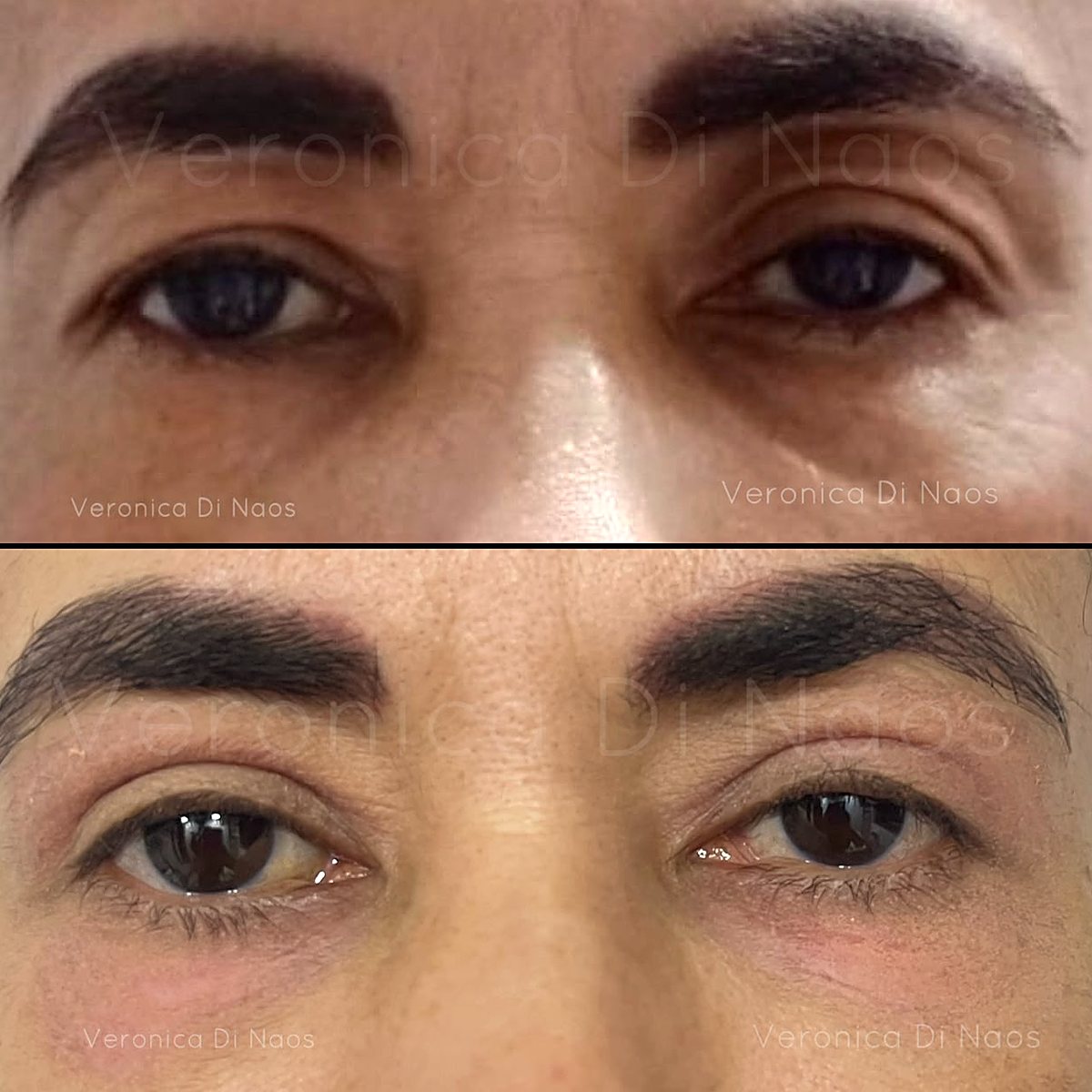 Caso real: párpados caídos antes, arriba, y la mirada más abierta después, abajo